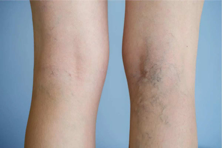 Varicose Vein Relief